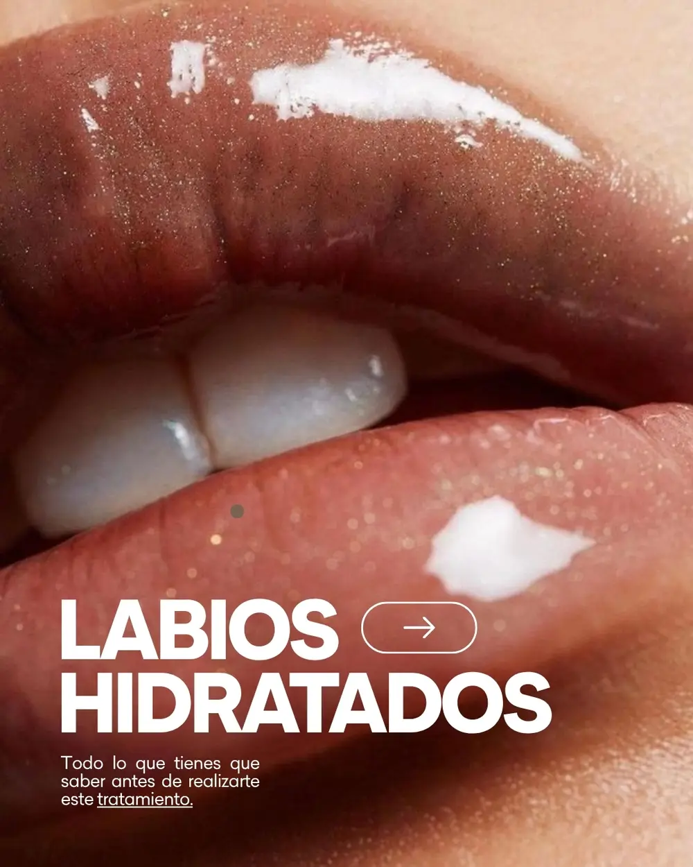 Labios: tratamiento de medicina estética en Atelier LyO