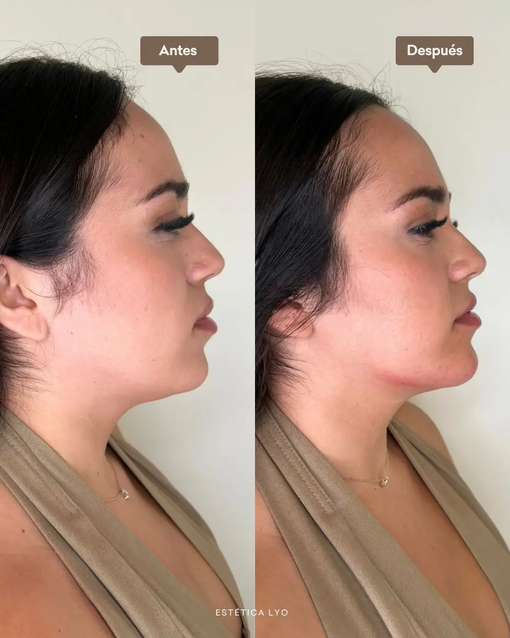 Antes y después: Armonía de perfil